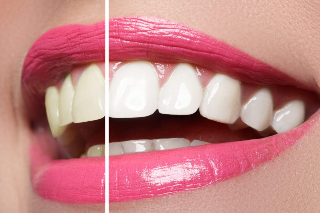 blanqueamiento dental en Cooldent