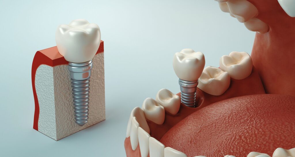 periimplantitis en Algeciras