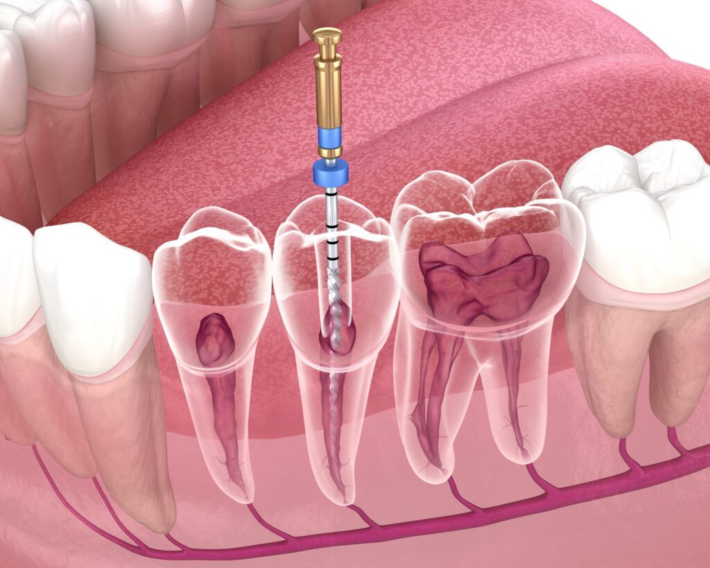 endodoncia