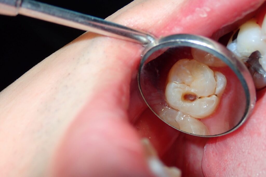caries dentales