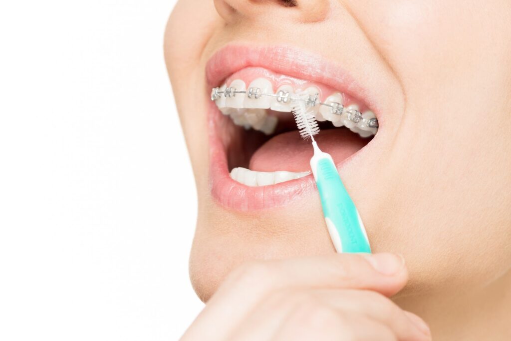 higiene oral con brackets