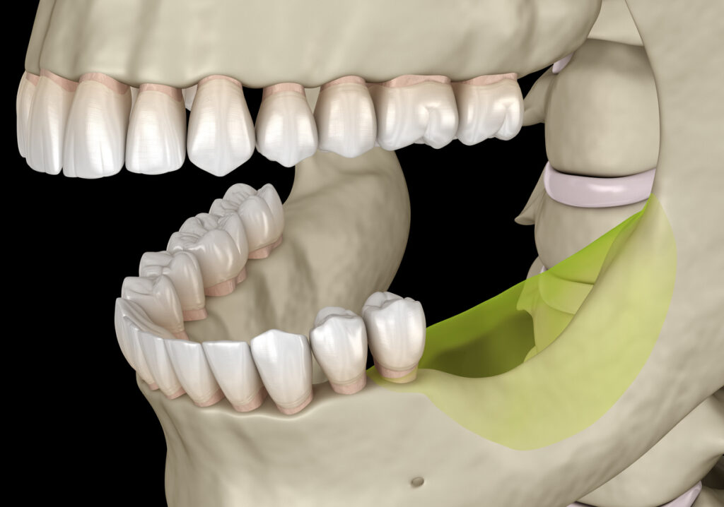 reabsorción ósea tras la pérdida dental