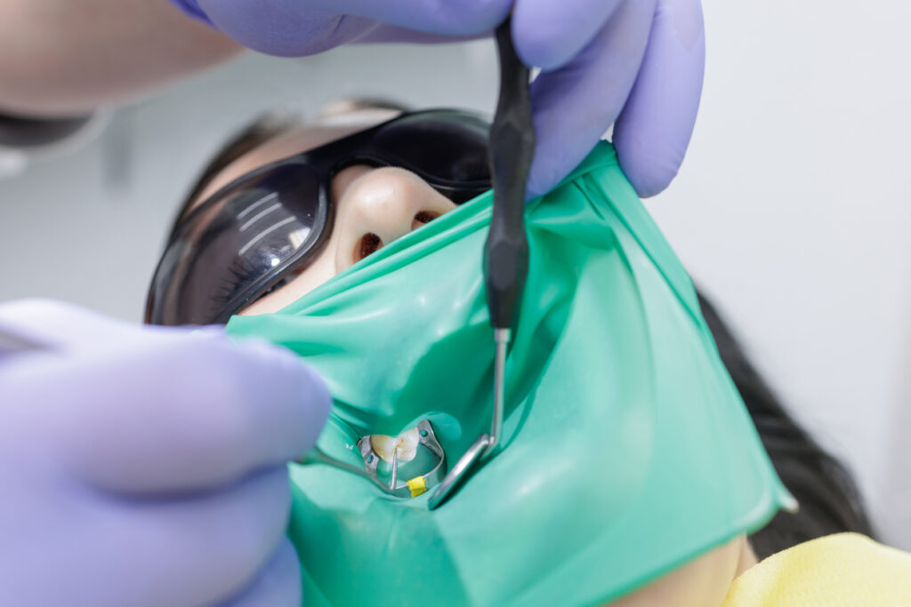 endodoncia en Estepona