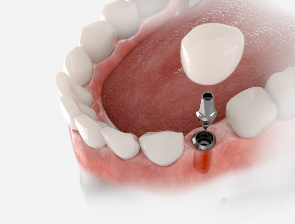 implantes de carga inmediata