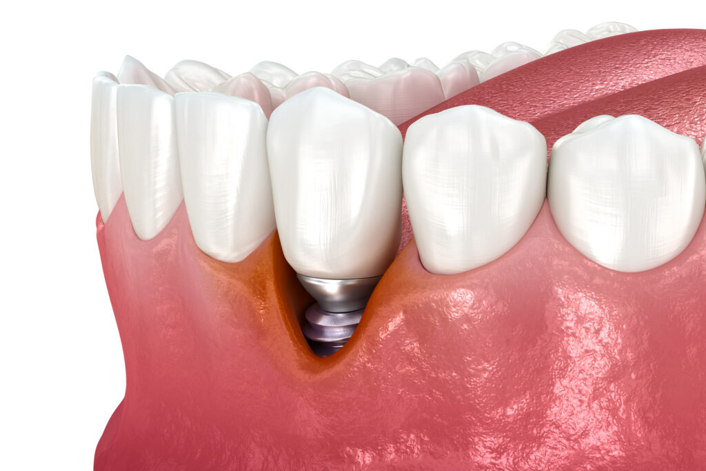 Mucositis periimplantaria