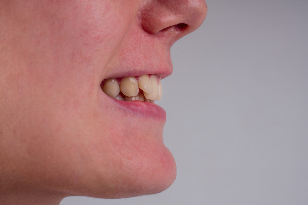 tipos de maloclusion dental y correccion de mordida