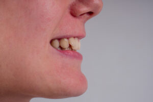 tipos de maloclusion dental y correccion de mordida